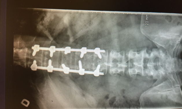 An X-ray, showing a broken back